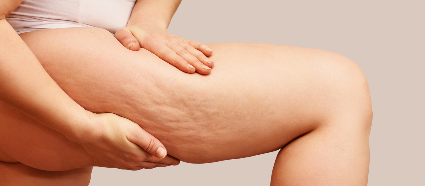 Cellulite on a Woman's Thigh