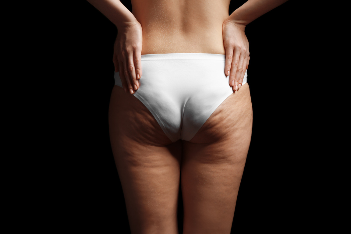 Person with Cellulite on Buttocks on Black Background